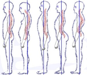 Dr. Allen Maryott Rocky Hill - Posture Types